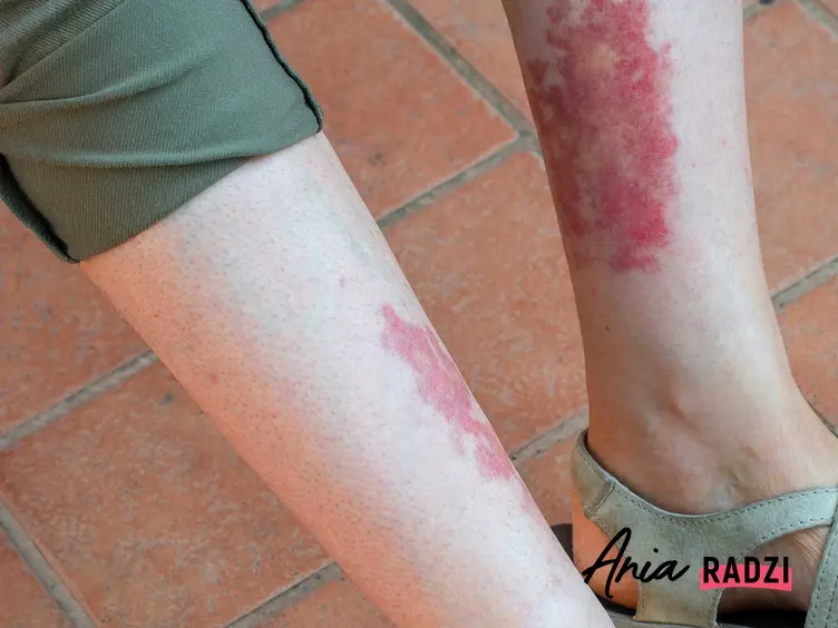 Duże czerwone plamy na nogach oraz informacje co mogą oznaczać plamki, wykwity i inne plamy na nogach