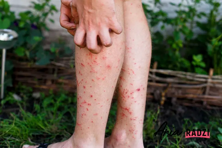 Czerwone plamy na nogach oraz plamki, wykwity i inne plamy na nogach, a także ich przyczyny, leczenie i zwalczanie