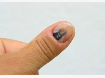 Ilustracja artykułu krwiak pod paznokciem - jak go usunąć i jak długo to trwa?