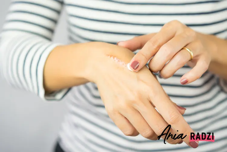 Kobieta smarująca maścią świeżą bliznę na dłoni oraz porady jak usunąć blizny
