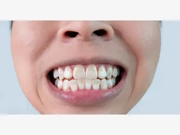 Ilustracja artykułu białe plamy na zębach - przyczyny, objawy, zwalczanie