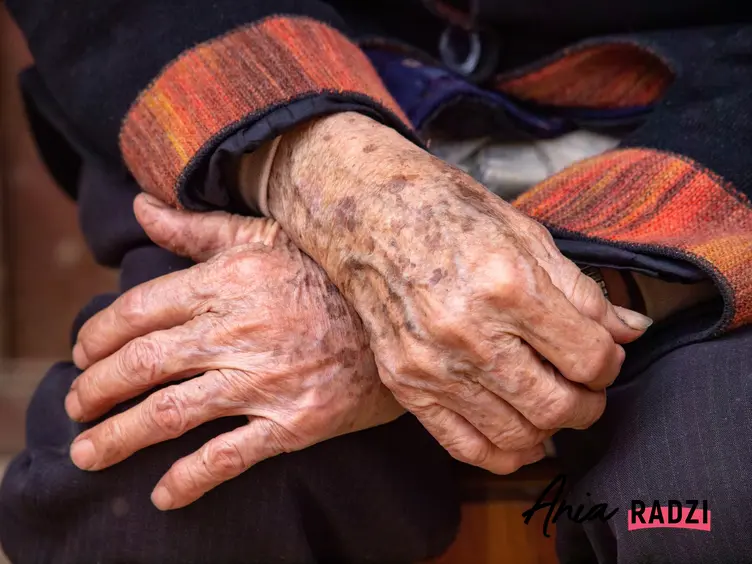 Złożone dłonie starszej osoby, a także czym są plamy soczewicowate i ich leczenie