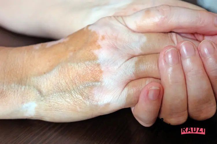 Białe plamy na skórze rąk, a także na ciele oraz powiązanie z nimi potencjalne choroby