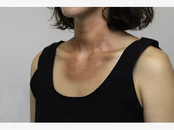 Ilustracja artykułu czerwone plamy na szyi i dekolcie - przyczyny i leczenie