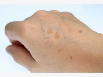 Ilustracja artykułu przebarwienia i plamy na dłoniach - przyczyny i leczenie