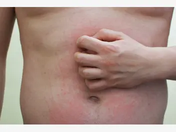 Ilustracja artykułu czerwone plamy na brzuchu - przyczyny, objawy, leczenie