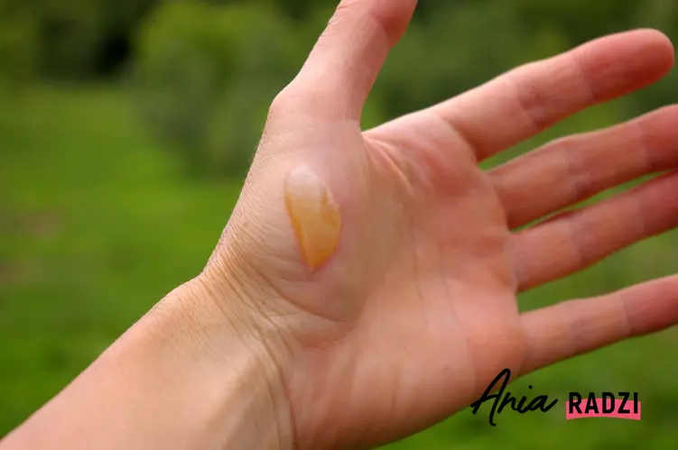 Bąbel na skóre dłoni po oparzeniu, dlaczego po oparzeniu na skórze robią się bąble, czy można samemu usuwać bąble po oparzeniu