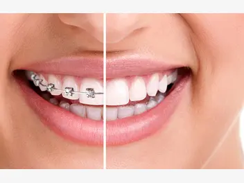 Ilustracja artykułu aparat ortodontyczny. jakie korzyści dla zdrowia?