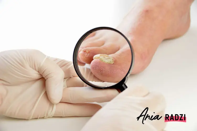 Grzybica paznokci oraz domowe sposoby na grzybicę paznokci, czyli leczenie grzybicy paznokci i naturalne metody, jak leczenie czosnkiem