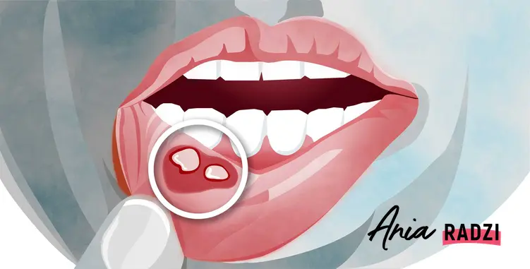 Domowe sposoby na afty w jamie ustnej, czyli naturalne leczenie aft i porady, jak walczyć z aftami na języku i dziąsłach