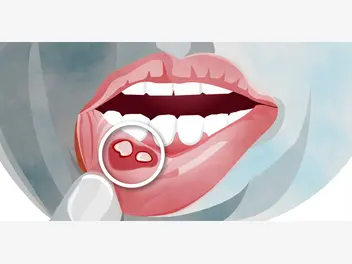 Ilustracja artykułu domowe sposoby na afty w jamie ustnej – 4 skuteczne metody leczenia