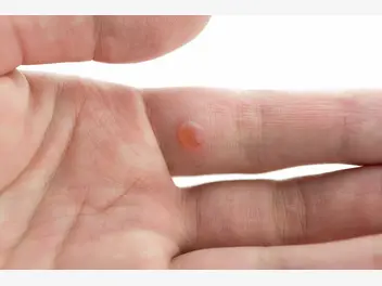Ilustracja artykułu kurzajka na palcu – przyczyny, wygląd, najlepsze sposoby leczenia
