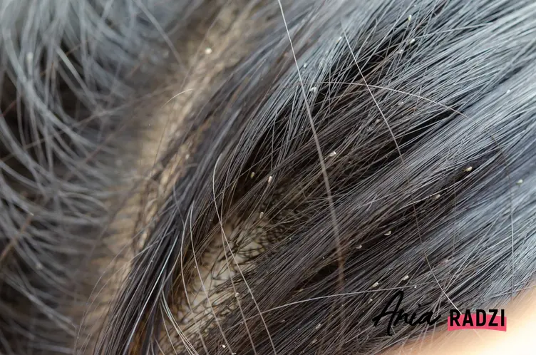 Gnidy i wszy we włosach oraz okres wylęgania gnidy we włosach, a także najlepsze sposoby i metody na wszy