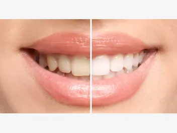 Ilustracja artykułu czym i jak szybko wybielić zęby? oto 5 najlepszych sposobów