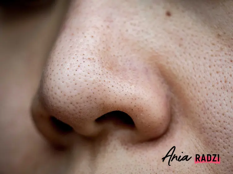 Czarne kropki na nosie, czyli wągry jako rodzaj czarnych zaskórników na nosie, a także ich usuwanie, zwalczanie i zapobieganie