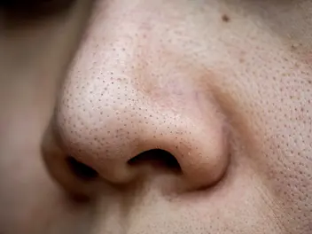 Ilustracja artykułu czarne kropki na nosie – przyczyny, objawy, skutki, sposoby zwalczania?