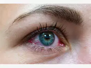 Ilustracja artykułu swędzą cię oczy? to może być alergia na truskawki!