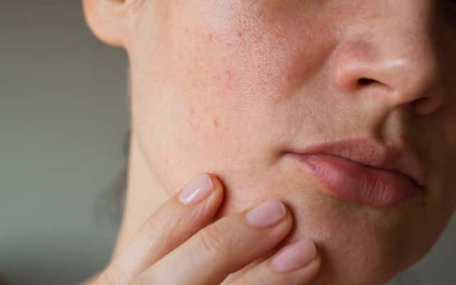 Czerwone plamy na twarzy - przyczyny i sposoby leczenia