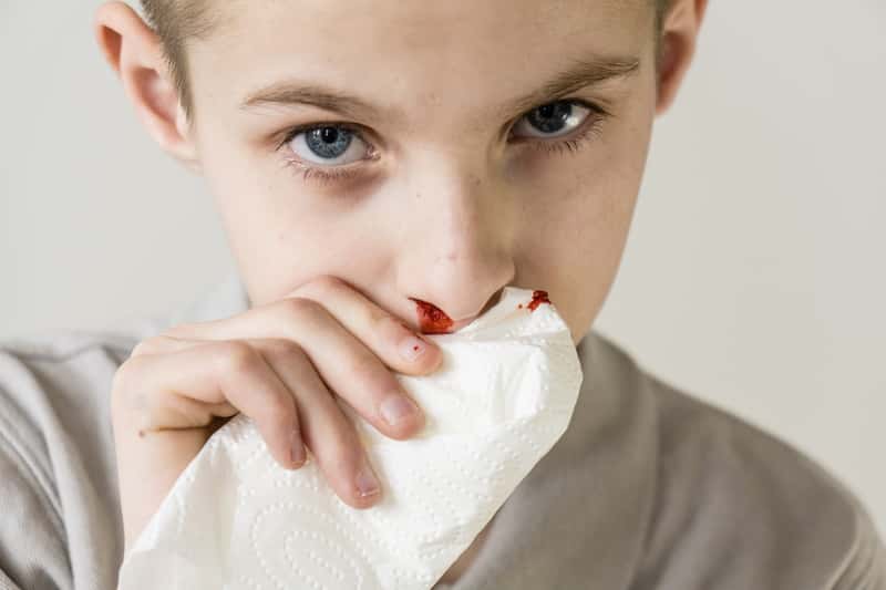 4 najczęstsze przyczyny krwawienia z nosa - zobacz, co możesz zrobić