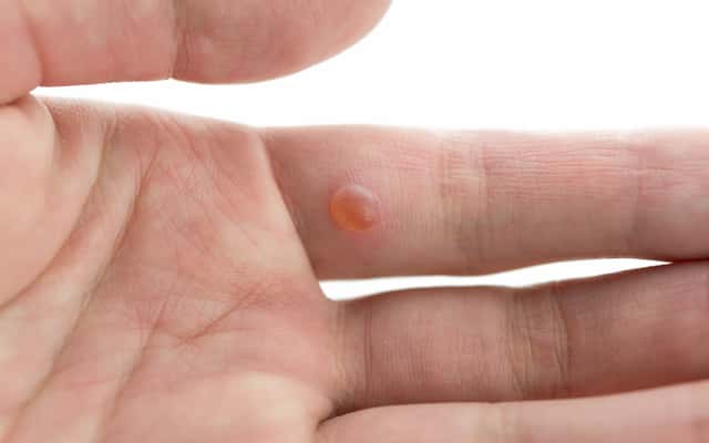 Kurzajka na palcu – przyczyny, wygląd, najlepsze sposoby leczenia