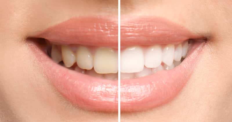 Czym i jak szybko wybielić zęby? Oto 5 najlepszych sposobów