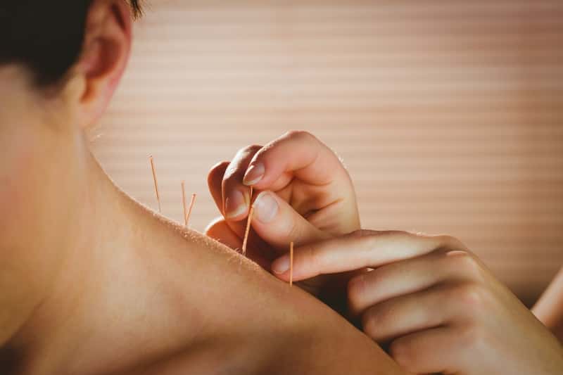 Na co pomaga akupunktura? Leczenie akupunkturą bez tajemnic!