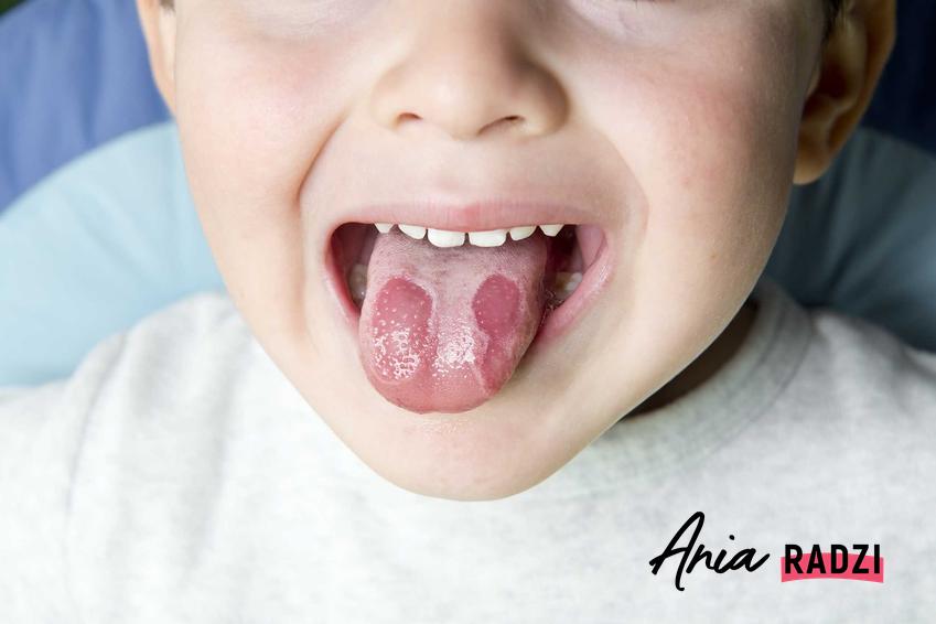 Plamy na języku u dziecka, a także plamy na języku i czerwone plamki na języku i ich znaczenie oraz choroby, które mogą być objawem