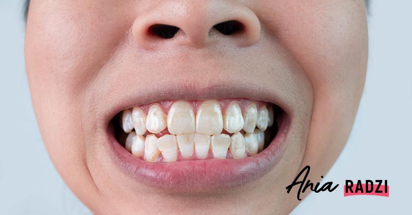 Wyeksponowane zęby z plamkami, a także co mogą oznaczać białe plamy na zębach i odbarwienia