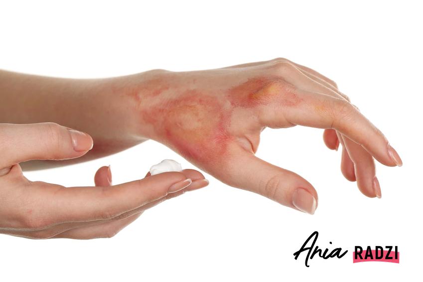Oparzone kobiece dłonie, oparzenia rąk, czym smarować skórę po oparzeniu, czy udać się do lekarza w przypadku oparzenia