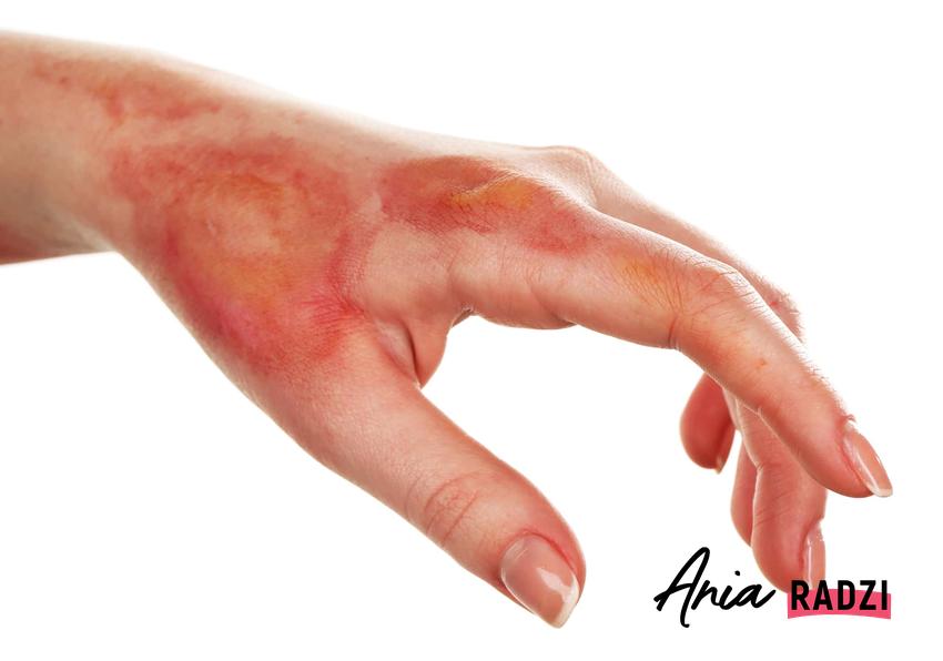 Poparzona dłoń, kobieca dłoń z poparzoną skórą, czy po oparzeniu zawsze zostają blizny, jakich preparatów używać na poparzenia skóry