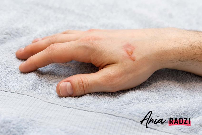 Rana na dłoni przypominające oparzenie, co to są oparzenia jakie są rodzaje oparzeń, burchle powstałe w wyniku choroby lub uszkodzenia skóry