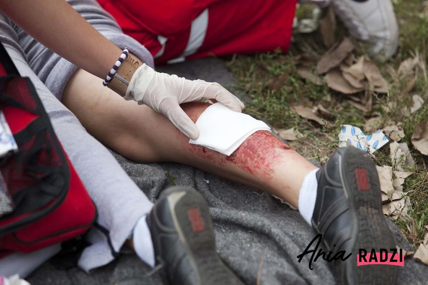 Czerwona skóra po oparzeniu, jak udzilać pierwsze pomocy osobie z pożaru, jakie są stopnie poparzenia skóry