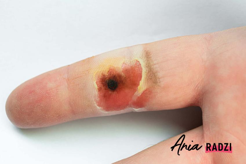 Palec poparzony żrącą substancją, głębokie poparzenie palca, czym się różnie oparzenie termiczne od oparzenia chemicznego, jak długo goją się różnego rodzaju oparzenia