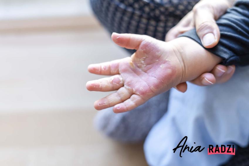 Oparzona dłoń dziecka, dziecko z poparzoną dłonią, jakie są dolegliwości spowodowane oparzeniem skóry, jak uśmierzyć ból po oparzeniach słonecznych