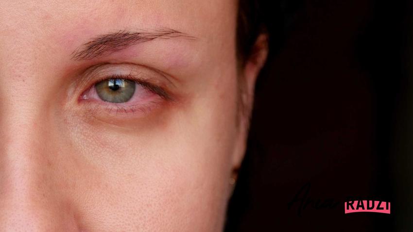 Zapalenie oka, czyli domowe sposoby na zapalenie spojówek, na przykład okłady jako leczenie domowe, a także specyfiki i leki na ból oczu
