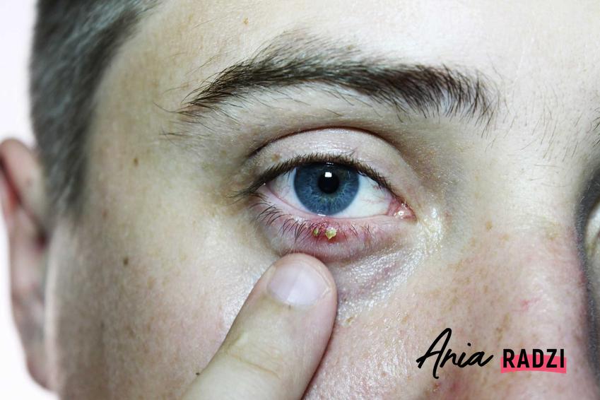 Jęczmień na oku oraz domowe sposoby na jęczmień na oku lub pod okiem oraz porady, jak usunąć jęczmień z oka