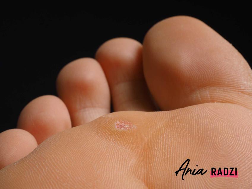 Kurzajka na stopie lub kurzajka na palcu i sposoby na kurzajki na palcach oraz przyczyny i leczenie oraz wymrażanie