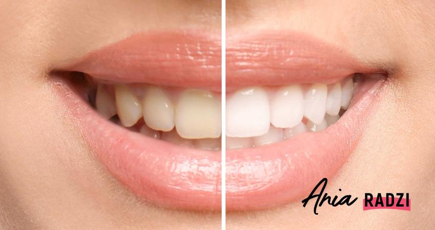 Wybielanie zębów przed i po oraz jak szybko wybielić zęby i czym wybielić zęby, by skutecznie wybielić zęby w domu