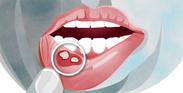Domowe sposoby na afty w jamie ustnej – 4 skuteczne metody leczenia