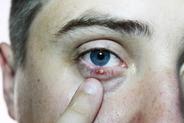 Domowe sposoby na jęczmień na oku – 3 sprawdzone metody leczenia