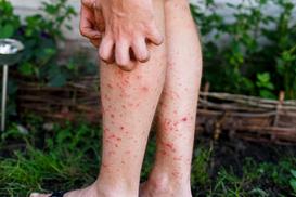 Czerwone plamy na nogach - przyczyny i leczenie krok po kroku