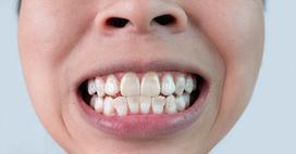 Białe plamy na zębach - przyczyny, objawy, zwalczanie