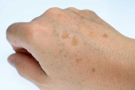 Przebarwienia i plamy na dłoniach - przyczyny i leczenie