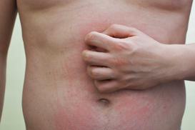 Czerwone plamy na brzuchu - przyczyny, objawy, leczenie