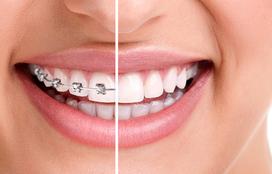 Aparat ortodontyczny. Jakie korzyści dla zdrowia?