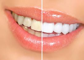 Domowe sposoby na wybielenie zębów – 6 skutecznych metod