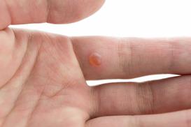 Kurzajka na palcu – przyczyny, wygląd, najlepsze sposoby leczenia